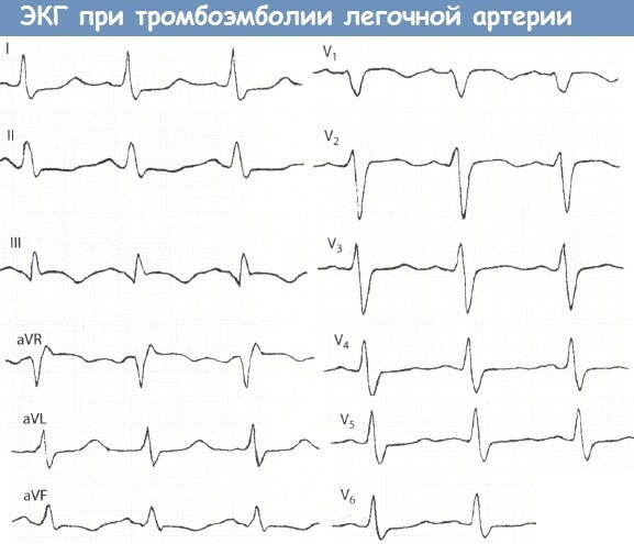 PE on ECG. Signs, photos, what it is, treatment