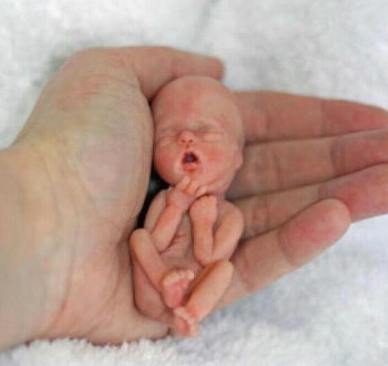 Abortion after 12 weeks( on term)
