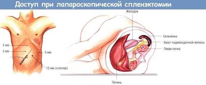 Splenomegaly. What is it, how to treat, causes of moderate, minor, portal, severe, analyzes