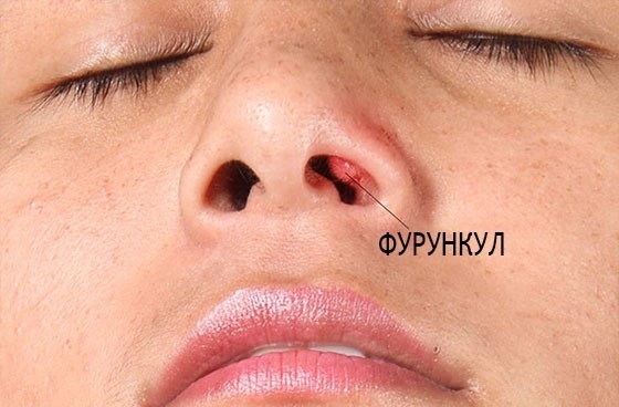 Boil in the nose. How to treat with ointment, antibiotic, folk remedies