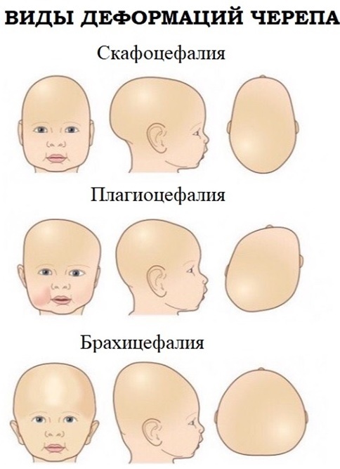 Kaukolės deformacija naujagimiams, vaikams, pristatant kelnes. Požymiai, simptomai, kaip ištaisyti