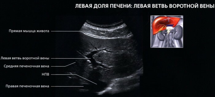 Segmentos de hígado en cortes de ultrasonido, tomografía computarizada, resonancia magnética. Esquema, foto