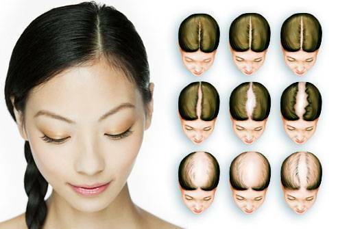 Stages of alopecia