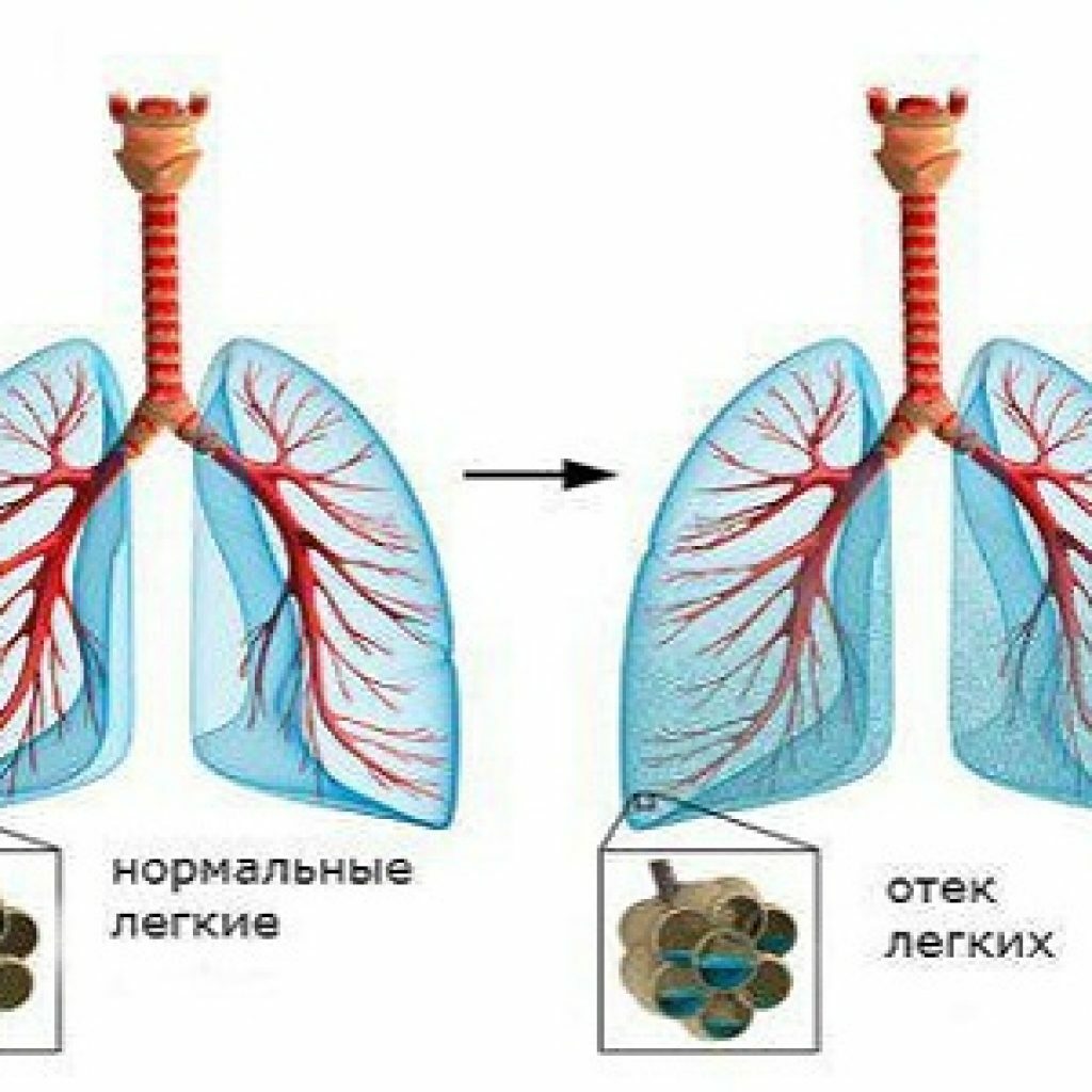 Lungerødem