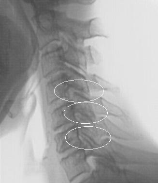 האוסטאופיטים של עמוד השדרה הצווארי יוצרים מפרקים חדשים בין החוליות - חוליות לא-חוליות
