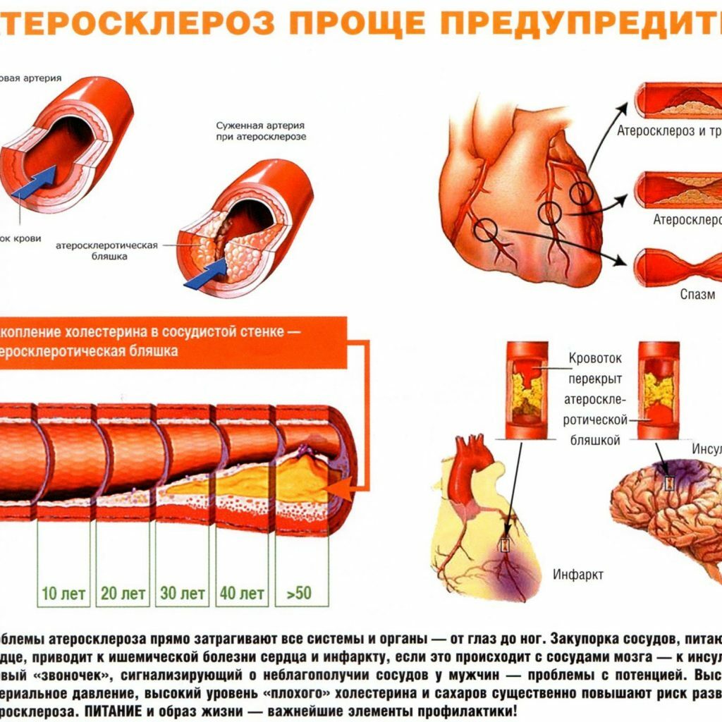 Cardiovascular atherosclerosis