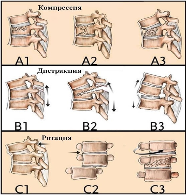 Fracture of the cervical vertebra. Consequences, symptoms, treatment