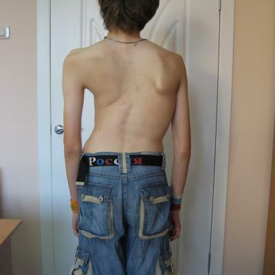 Scoliosis of 3rd degree