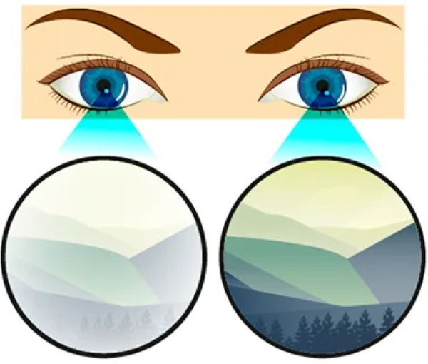 תיקון ראייה לאסטיגמציה, קוצר ראייה, היפראופיה. ביקורות