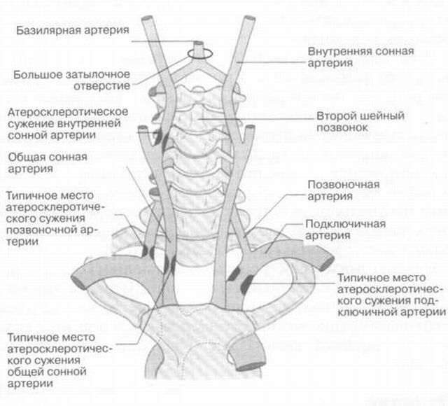 Insufficienza vertebro-basilare: cause, sintomi e trattamento dell'IVB