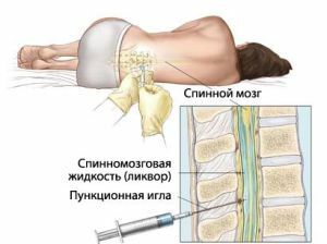 Lesi inflamasi akut pada meningomielitis tulang belakang