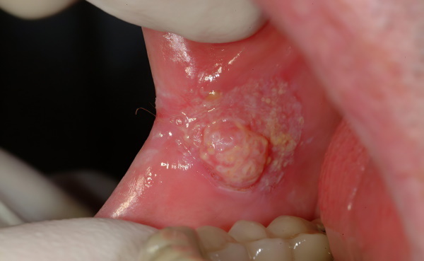 Leukoplakia of the oral cavity. Photo, differential diagnostics