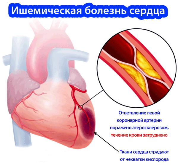 Hjerteglykosider medicin. Virkningsmekanismen, klassificering, farmakologi