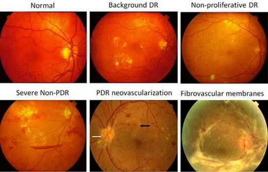 Stages of retinopathy