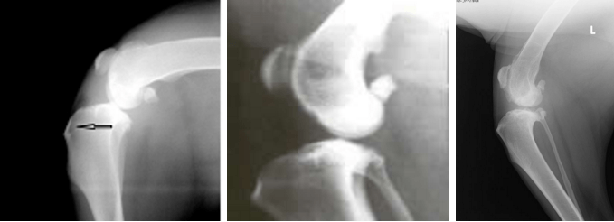 Die Röntgenzeichen der PCD-Ruptur werden durch die Verschiebung der Tibiakondylen relativ zum Femur verursacht