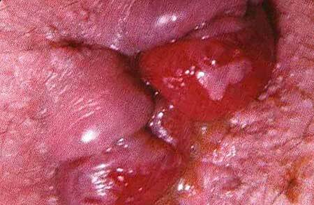Inflamația nodului hemoroid