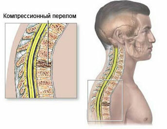 Frattura di compressione della colonna vertebrale