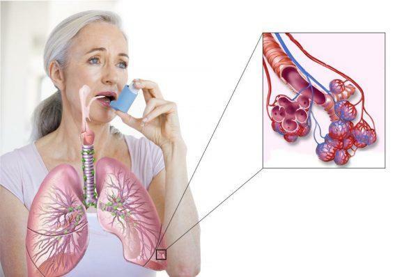 Symptoms of bronchial asthma in the early stages of the disease