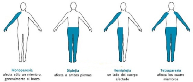 Monoplegia - pathological paralysis of one limb