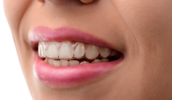 The girl has crooked teeth. Before and after photos, how to fix, methods with and without braces
