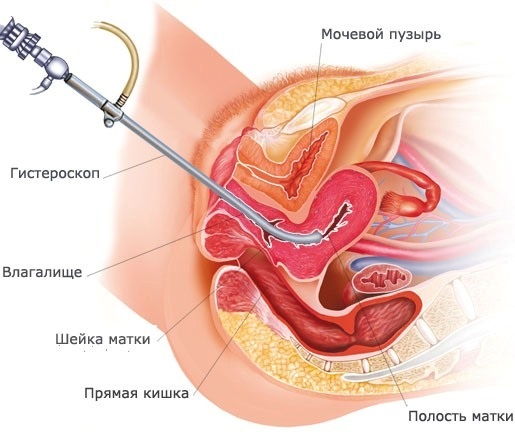 Disfungsi ovarium. Apa itu pada wanita, remaja, gejala, pengobatan, penyebab