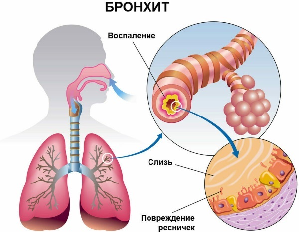 La bronchite chronique. Les symptômes, le traitement, les lignes directrices cliniques. complications possibles