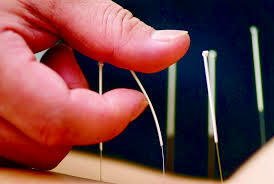 Nevraljisi olan akupunktur