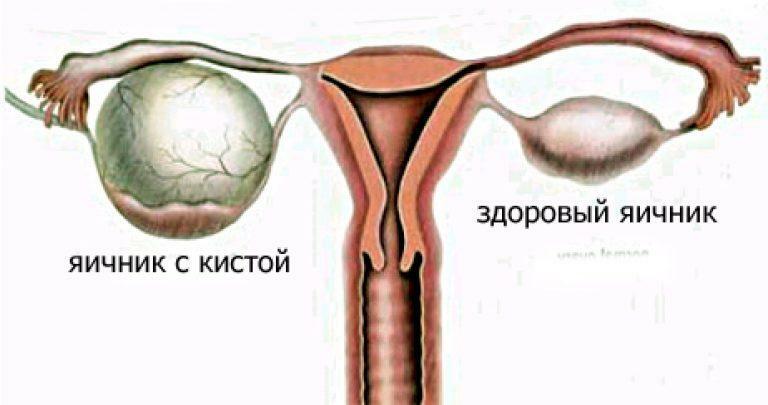 Ce este chistul ovarian periculos la femei