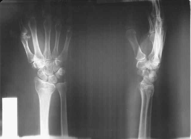 X-ray van de straal