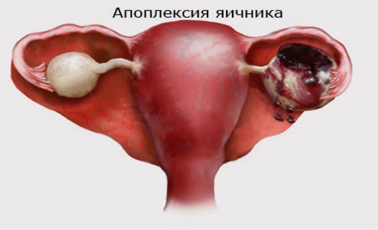 Apoplexy ovarium