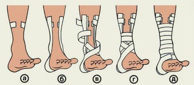 Auf dem Foto eine Schritt-für-Schritt-Anleitung zum Anlegen einer Bandage mit einer Sprunggelenkdislokation