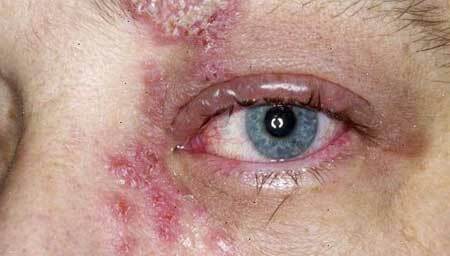 Symptoms of shingles on the head and face