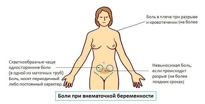 Pain in ectopic pregnancy