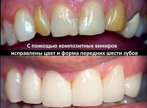 Kompositfaner utan att tänderna vänder. Nackdelar, fördelar, hur de sätter, pris