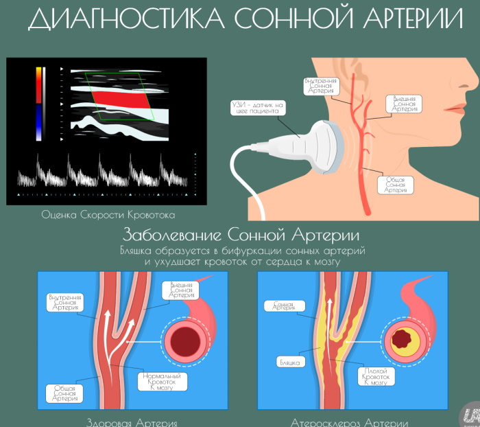 Ateroskleróza cév krku, hlavy. Příznaky a léčba u starších osob