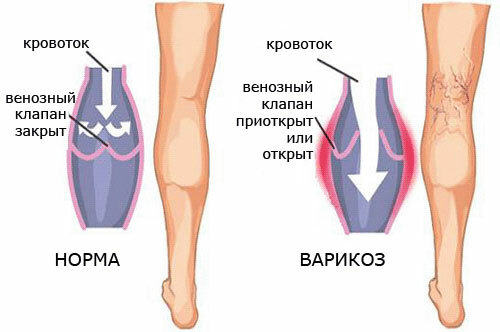 Krampfadern an den Beinen, Symptome und Behandlung
