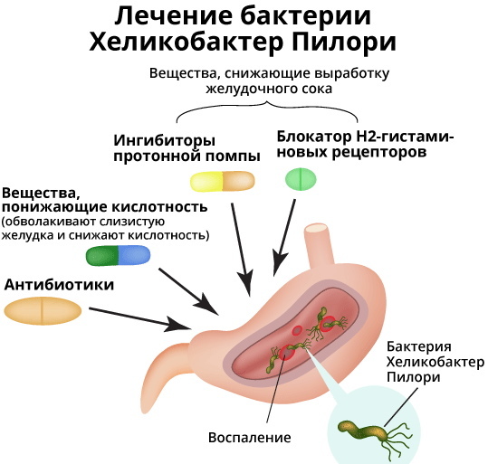 Bacteria Helicobacter pylori en el estómago. Cómo tratar con medicación