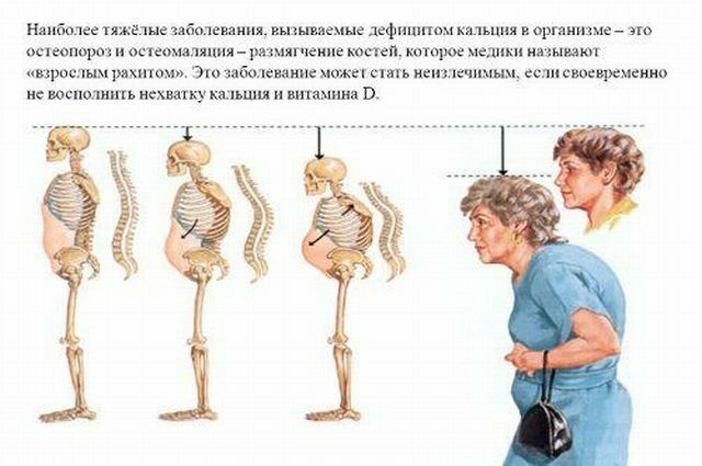 osteomalacie a osteoporózy