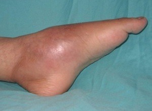 Foot osteomyelitis