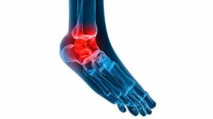 osteoarthritis of the ankle