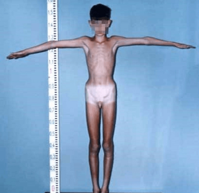 a boy with hypogonadism
