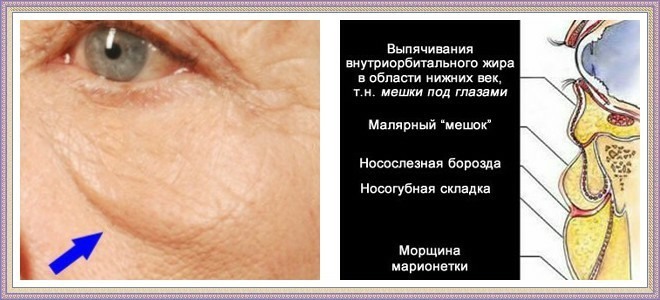 שקיות צביעה מתחת לעיניים. תמונות, סיבות וטיפול