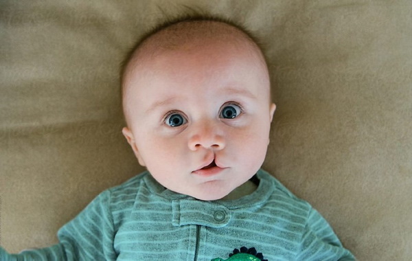 Gespleten lip bij een pasgeboren baby. Foto, redenen, operatie