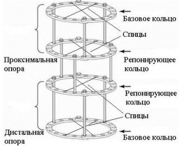 Ilizarov apparatus on the leg, arm, thigh. Installation, photo how, how much to wear, take care of