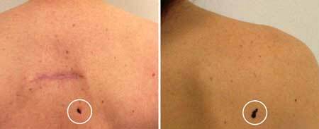 Cáncer de piel: fotos, etapa inicial, síntomas y tratamiento