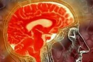 Išorinė smegenų hidrocefalija - tipai, nuotraukos ir ligos gydymas
