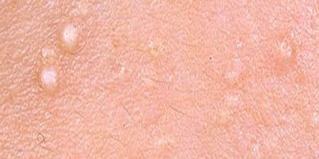 Milium en la piel, foto 2