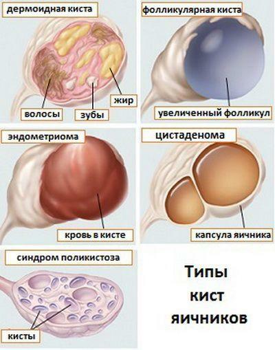 Typer av äggstockar cystor