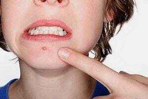 Teenage pimples