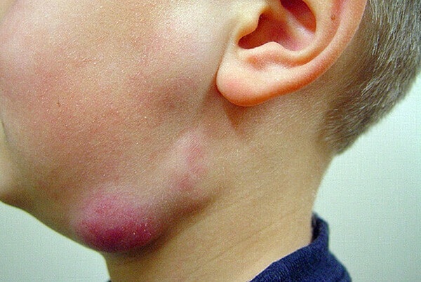 Lymphadenitis on the neck. Causes, symptoms, treatment, antibiotics, ointments